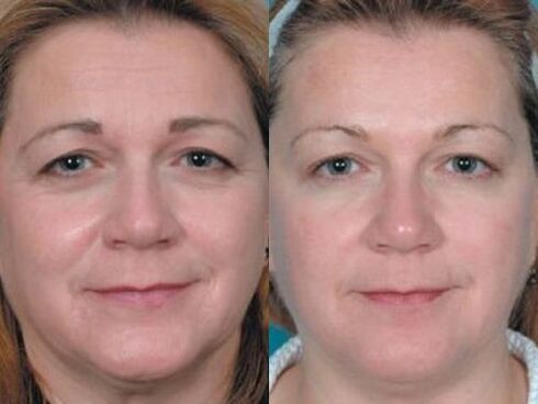 pictures before and after plasma skin rejuvenation