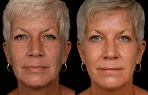 The result of laser treatment on facial skin - reduction of wrinkles
