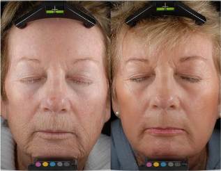Before and after rejuvenation with fractional lasers