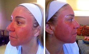 Redness of the face after laser rejuvenation