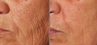photos before and after fractional skin rejuvenation