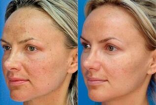 photos before and after skin rejuvenation with the device